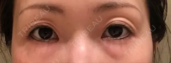 二重埋没 千里中央ゆみスキンクリニック DAY 106 メイン用