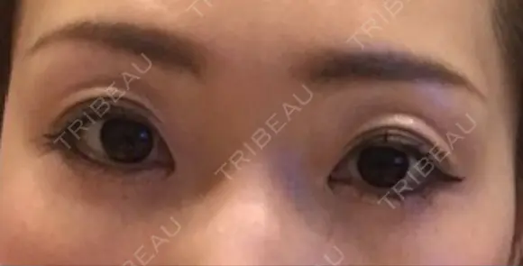 二重埋没 千里中央ゆみスキンクリニック AFTER メイン用