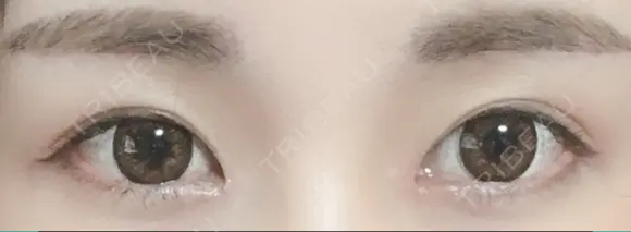 目頭切開 / 上まぶたたるみ取り / 眉下切開 Lovelyan整形外科 DAY 33 メイン用