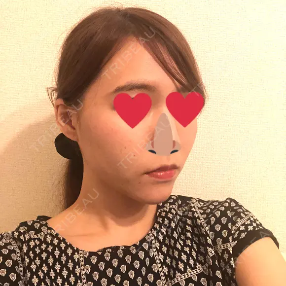 糸リフト / ヒアルロン酸注入（あご） / ボトックス（エラ・小顔） / 脂肪溶解注射（顔） 品川スキンクリニック熊本院 DAY 4 メイン用