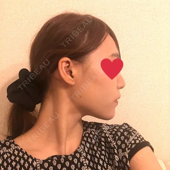 糸リフト / ヒアルロン酸注入（あご） / ボトックス（エラ・小顔） / 脂肪溶解注射（顔） 品川スキンクリニック熊本院 DAY 4 メイン用