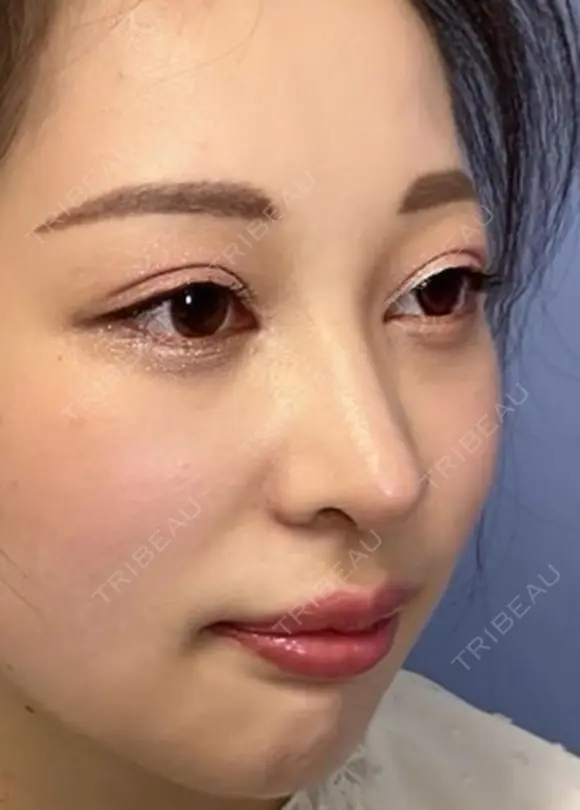 二重埋没 / 目頭切開 / 鼻尖形成（切開） / 鼻中隔延長（切開） / 軟骨移植 / ヒアルロン酸注入（鼻） / ヒアルロン酸注入（あご） 湘南美容クリニック 新潟院 DAY 32 メイン用