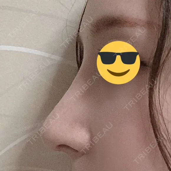 鼻尖形成（切開） / 鼻中隔延長（切開） / 軟骨移植 / 骨切幅寄せ / ワシ鼻修正・ハンプ切除 / 眉間プロテーゼ グロービー美容整形外科 AFTER メイン用