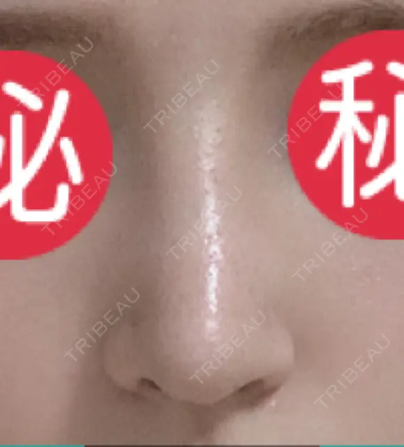鼻尖形成（切開） / 鼻中隔延長（切開） / 軟骨移植 / 骨切幅寄せ / ワシ鼻修正・ハンプ切除 / 眉間プロテーゼ グロービー美容整形外科 DAY 22 メイン用