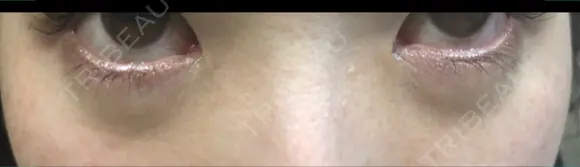 クマ治療 / 下まぶたたるみ取り / 下まぶたの脂肪取り コスメディカルクリニック シンシア 渋谷院 DAY 7 メイン用