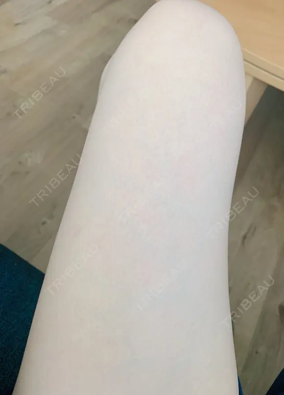 クマ治療 / 額を丸く / 脂肪吸引（脚） / レディエッセ注入（鼻） THE CLINIC（ザ・クリニック） 東京院 DAY 14 メイン用