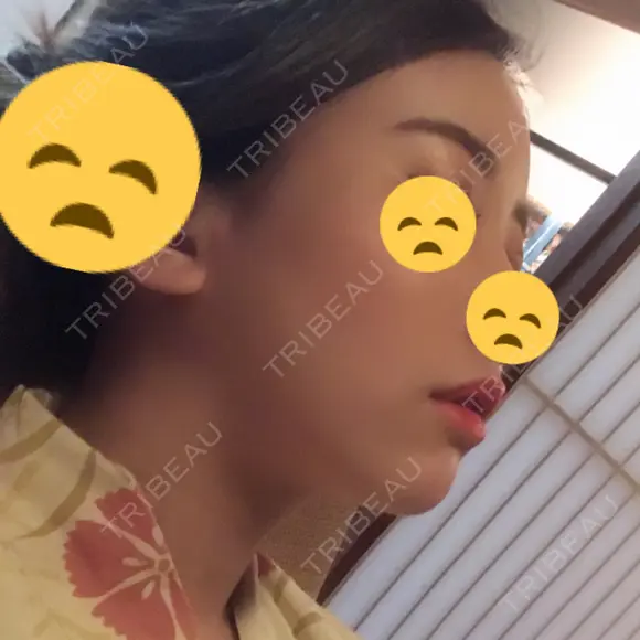 脂肪吸引（顔） / 額を丸く / 脂肪吸引（脚） / こめかみ形成 / 輪郭修正 / 脂肪注入（額） / 脂肪注入（輪郭） フレッシュ整形外科 DAY 176 メイン用