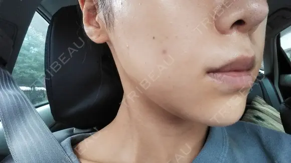 ニキビ治療 The Beauty Clinic SENDAI DAY 0 メイン用