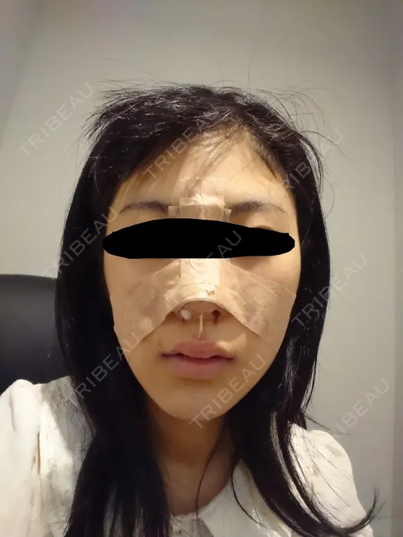 隆鼻術 / 小鼻縮小（切開） 湘南美容クリニック 熊本院 AFTER メイン用