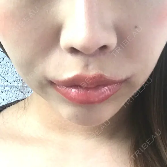 人中短縮 / 口角挙上 清潭女神美容外科 DAY 30 メイン用