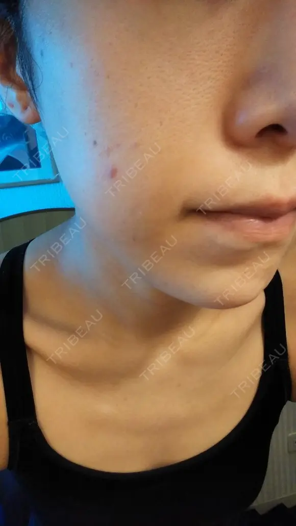 ニキビ治療 The Beauty Clinic SENDAI DAY 3 メイン用