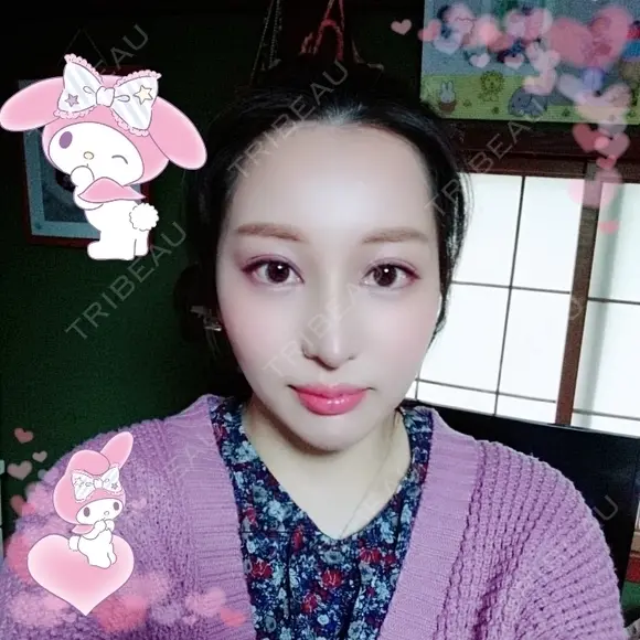 二重埋没 / 目頭切開 / 鼻尖形成（切開） / 鼻中隔延長（切開） / 軟骨移植 / ヒアルロン酸注入（鼻） / ヒアルロン酸注入（あご） 湘南美容クリニック 新潟院 DAY 13 メイン用