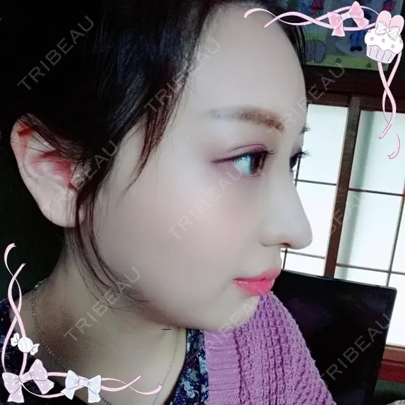 二重埋没 / 目頭切開 / 鼻尖形成（切開） / 鼻中隔延長（切開） / 軟骨移植 / ヒアルロン酸注入（鼻） / ヒアルロン酸注入（あご） 湘南美容クリニック 新潟院 DAY 13 メイン用