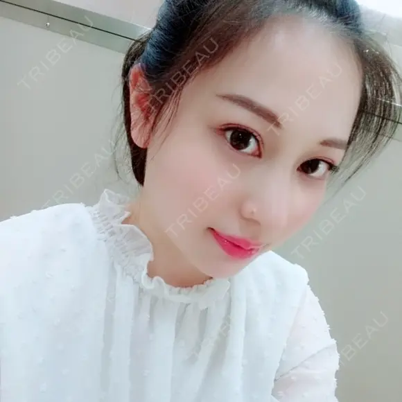 二重埋没 / 目頭切開 / 鼻尖形成（切開） / 鼻中隔延長（切開） / 軟骨移植 / ヒアルロン酸注入（鼻） / ヒアルロン酸注入（あご） 湘南美容クリニック 新潟院 DAY 32 メイン用