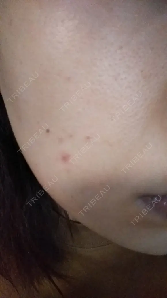 ニキビ治療 The Beauty Clinic SENDAI DAY 4 メイン用