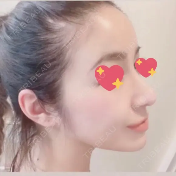 鼻尖形成（切開） / 鼻中隔延長（切開） / 脂肪注入（額） / 脂肪注入（輪郭） ビーザニュー美容整形外科（旧コノピ美容整形外科） DAY 122 メイン用