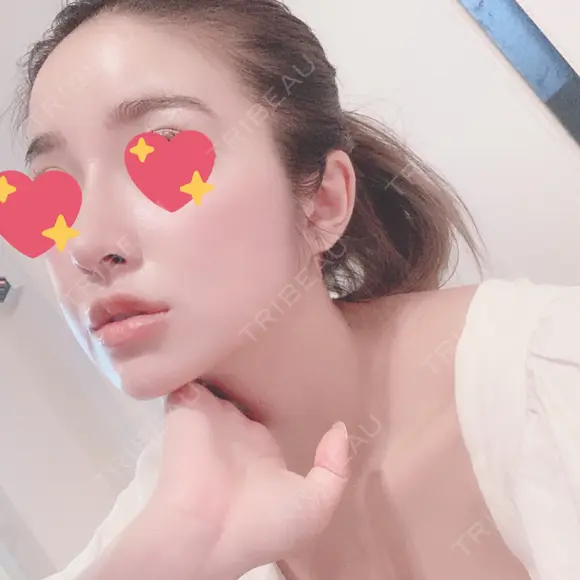 鼻尖形成（切開） / 鼻中隔延長（切開） / 脂肪注入（額） / 脂肪注入（輪郭） ビーザニュー美容整形外科（旧コノピ美容整形外科） DAY 122 メイン用