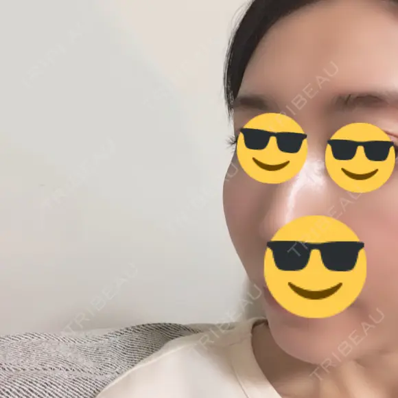 骨削り（頬） / 輪郭修正 マックスファクス銀座クリニック DAY 31 メイン用