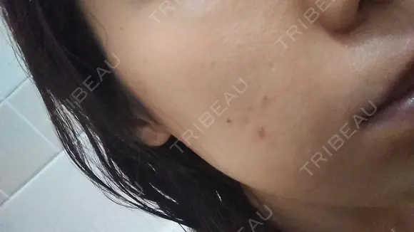 ニキビ治療 The Beauty Clinic SENDAI AFTER メイン用
