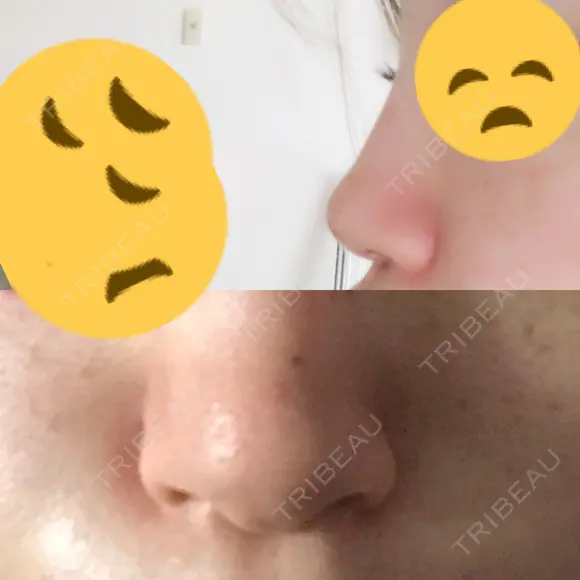 隆鼻術 / 鼻中隔延長（切開） 牧野皮膚科形成外科内科医院 美容外科・形成外科・抗加齢医学外来 DAY 173 メイン用