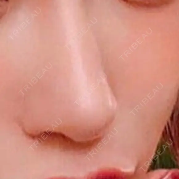 隆鼻術 / 鼻中隔延長（切開） 牧野皮膚科形成外科内科医院 美容外科・形成外科・抗加齢医学外来 DAY 274 メイン用