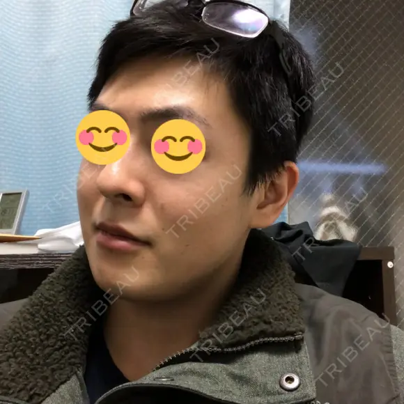 ほくろ・いぼ切除（肌） 吉田美容形成クリニック DAY 180 メイン用