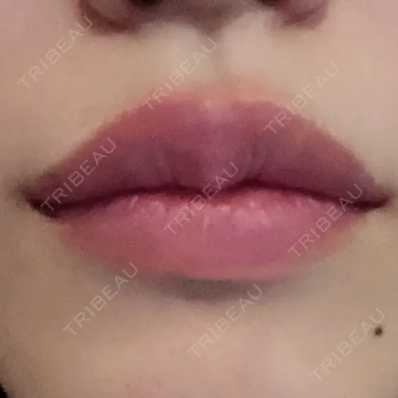 ヒアルロン酸注入（唇） TCB東京中央美容外科 堺院 DAY 0 メイン用