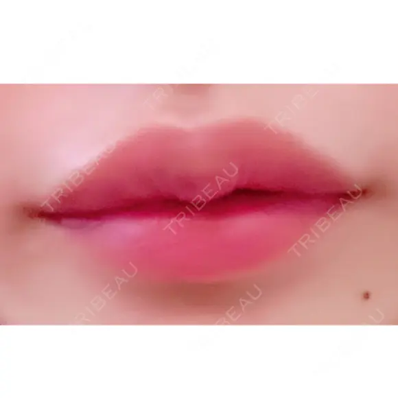 ヒアルロン酸注入（唇） TCB東京中央美容外科 堺院 AFTER メイン用