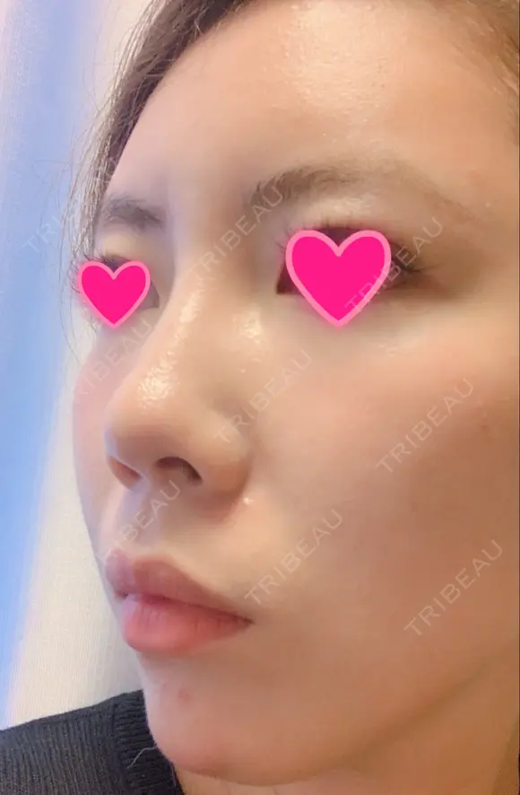 クマ治療 / 額を丸く / 脂肪吸引（脚） / レディエッセ注入（鼻） THE CLINIC（ザ・クリニック） 東京院 DAY 22 メイン用