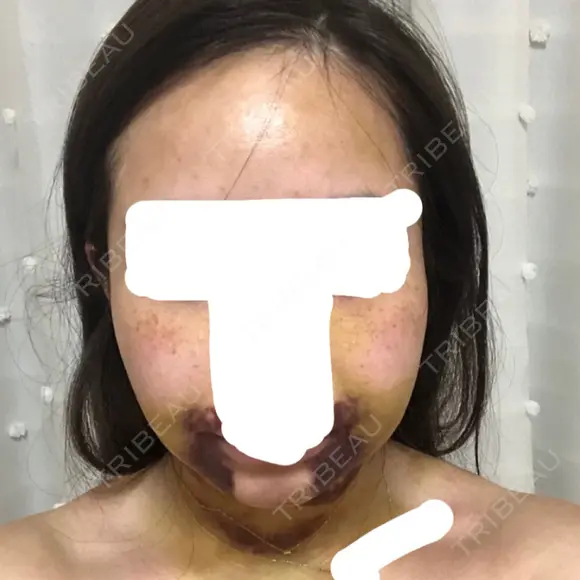 バッカルファット除去 / 脂肪吸引（顔） / ボトックス（あご） / 水光注射（ハリ・美肌） / ヒアルロン酸注入（あご） / ボトックス（エラ・小顔） / 脂肪溶解注射（顔） / ヒアルロン酸注入（唇） エートップ美容整形外科 DAY 7 メイン用