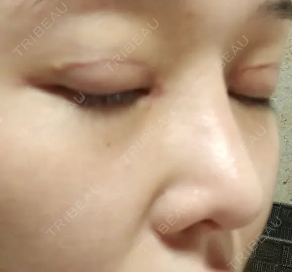 二重切開 / 目頭切開 / 眼瞼下垂（切開） / 隆鼻術 / 目尻切開 / 上まぶたたるみ取り / 軟骨移植 湘南美容クリニック 岡山院 DAY 31 メイン用