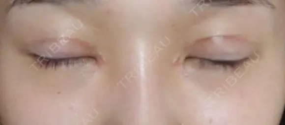 二重切開 / 目頭切開 / 眼瞼下垂（切開） / 隆鼻術 / 目尻切開 / 上まぶたたるみ取り / 軟骨移植 湘南美容クリニック 岡山院 DAY 31 メイン用