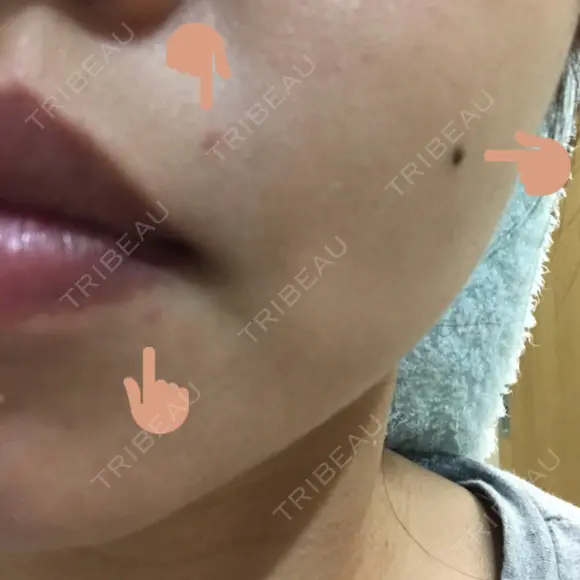 ほくろ・いぼ切除（肌） / YAGレーザー ラコスタ辻堂スキンクリニック DAY 4 メイン用