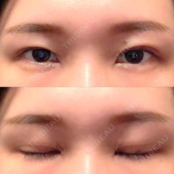 二重埋没 聖心美容クリニック 札幌院 DAY 28 メイン用