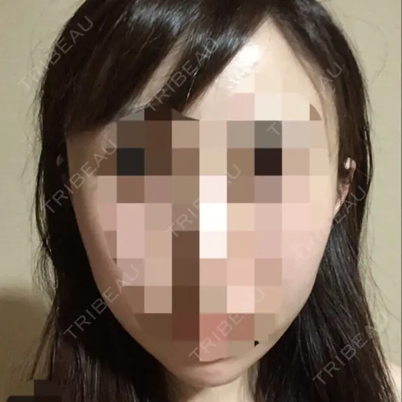 骨切り（あご） / 骨削り（エラ） / 骨削り（頬） ボンディ美容整形外科（旧リオン整形外科） DAY 30 メイン用