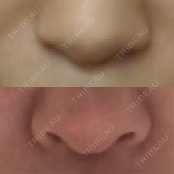 隆鼻術 / 鼻中隔延長（切開） 牧野皮膚科形成外科内科医院 美容外科・形成外科・抗加齢医学外来 DAY 177 メイン用