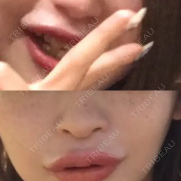 隆鼻術 / 鼻中隔延長（切開） 牧野皮膚科形成外科内科医院 美容外科・形成外科・抗加齢医学外来 DAY 274 メイン用