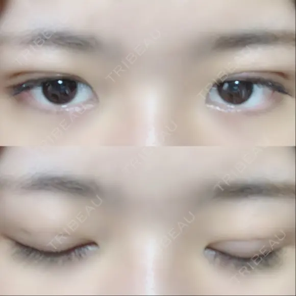 二重埋没 / 眼瞼下垂（切開） アリナガ美容外科 DAY 10 メイン用