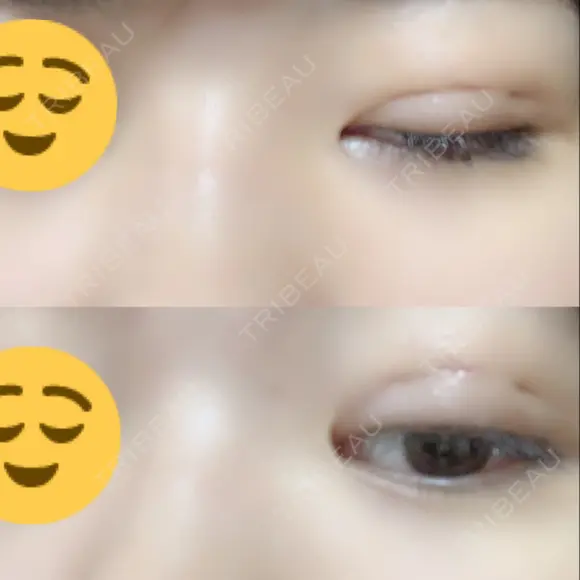 二重埋没 / 眼瞼下垂（切開） アリナガ美容外科 DAY 10 メイン用
