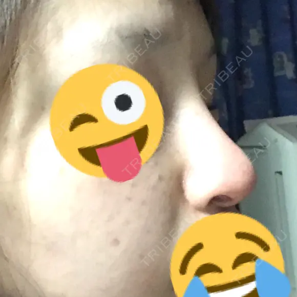 隆鼻術 / 鼻中隔延長（切開） 牧野皮膚科形成外科内科医院 美容外科・形成外科・抗加齢医学外来 DAY 191 メイン用