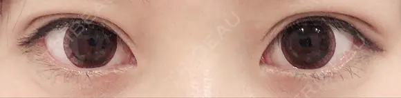 二重埋没 城本クリニック 姫路院 DAY 95 メイン用