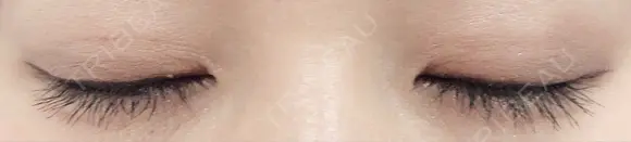 二重埋没 城本クリニック 姫路院 DAY 95 メイン用