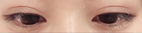 二重埋没 城本クリニック 姫路院 DAY 95 メイン用