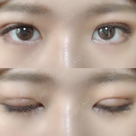 二重埋没 / 眼瞼下垂（切開） アリナガ美容外科 DAY 12 メイン用