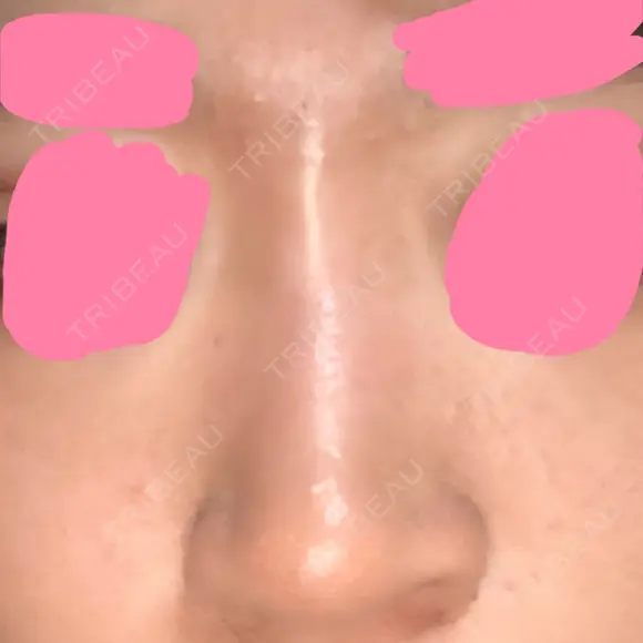 ヒアルロン酸注入（鼻） 神田美容外科形成外科医院 DAY 0 メイン用