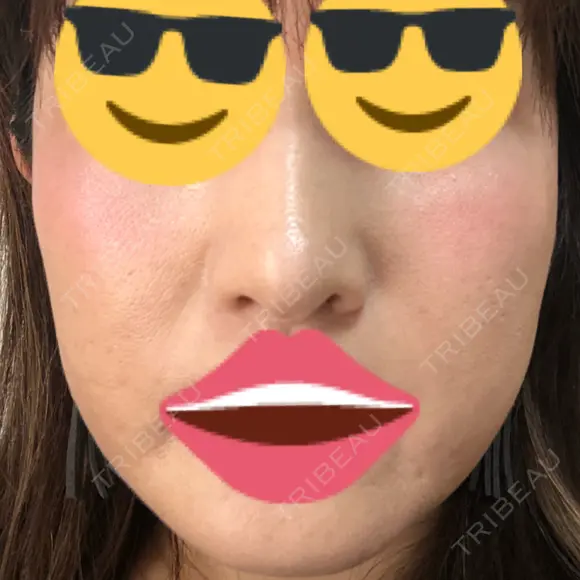 プラセンタ注射 / シミ取りレーザー 仁愛クリニック AFTER メイン用