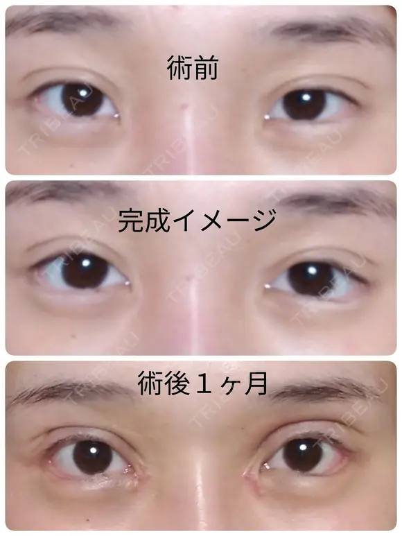 二重切開 / 目頭切開 / 眼瞼下垂（切開） / 隆鼻術 / 目尻切開 / 上まぶたたるみ取り / 軟骨移植 湘南美容クリニック 岡山院 DAY 38 メイン用
