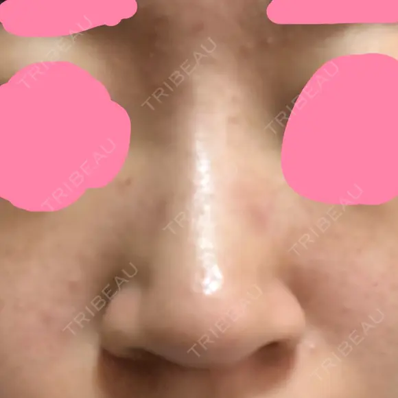 ヒアルロン酸注入（鼻） 神田美容外科形成外科医院 DAY 1 メイン用