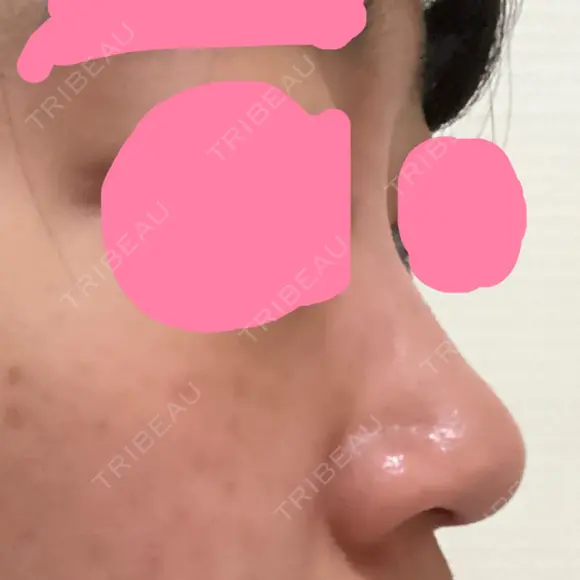 ヒアルロン酸注入（鼻） 神田美容外科形成外科医院 DAY 1 メイン用