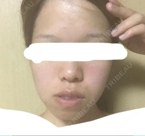 糸リフト / バッカルファット除去 / ボトックス（エラ・小顔） 湘南美容クリニック 静岡院 DAY 22 メイン用